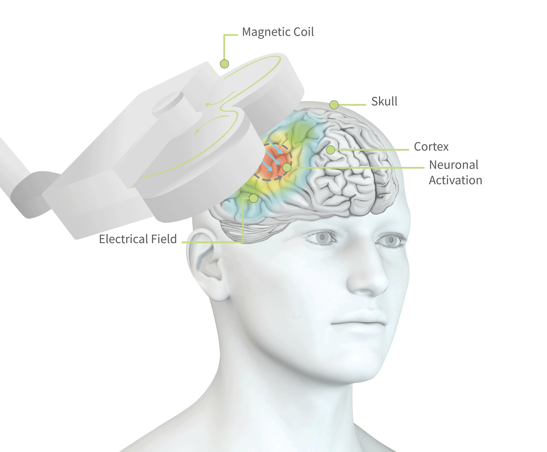 TMS Therapy for Depression & OCD | neurocare clinics Australia